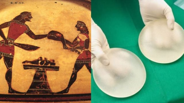 Προσθετική στήθους στην Αρχαία Ελλάδα: Κι όμως οι Αρχαίες Ελληνίδες έβαζαν εμφυτεύματα στα στήθη τους