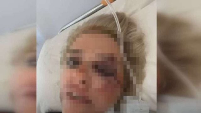 Καλαμάτα: Συγκλονίζει 34χρονη που την κατασπάραξαν σκυλιά – «Φοβάμαι να κυκλοφορήσω στον δρόμο! Παραλίγο να χάσω τη ζωή μου» (Video)