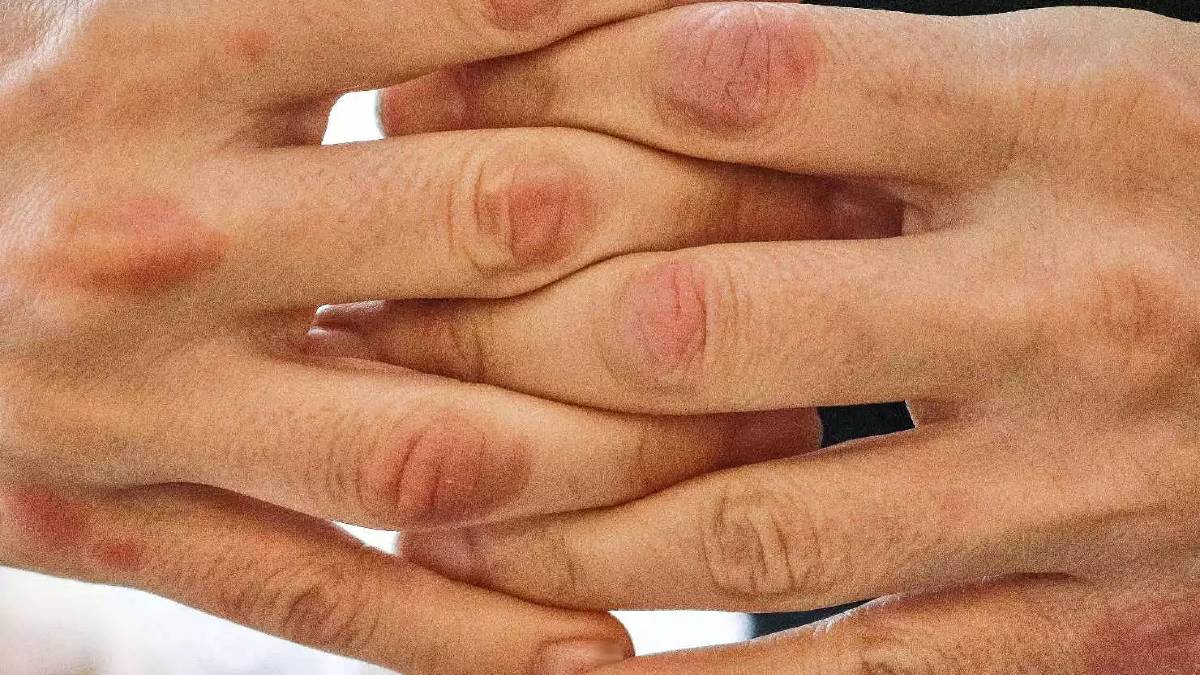Παρουσίαση του Bimekizumab στο 18ο Πανελλήνιο Συνέδριο Δερματολογίας