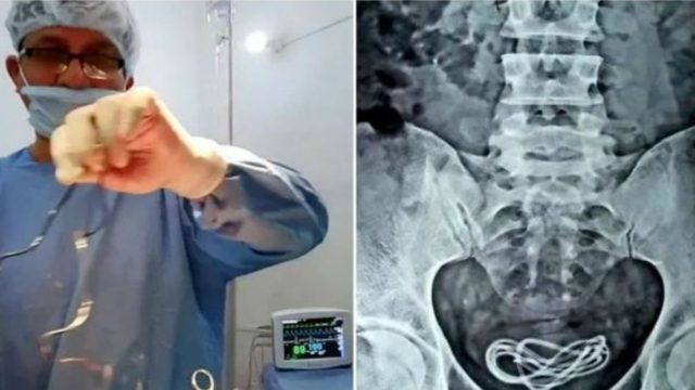 30χρονος πήγε στο νοσοκομείο με αφόρητους πόνους στην κοιλιά – Άφωνος ο γιατρός μόλις είδε την ακτινογραφία (photo)