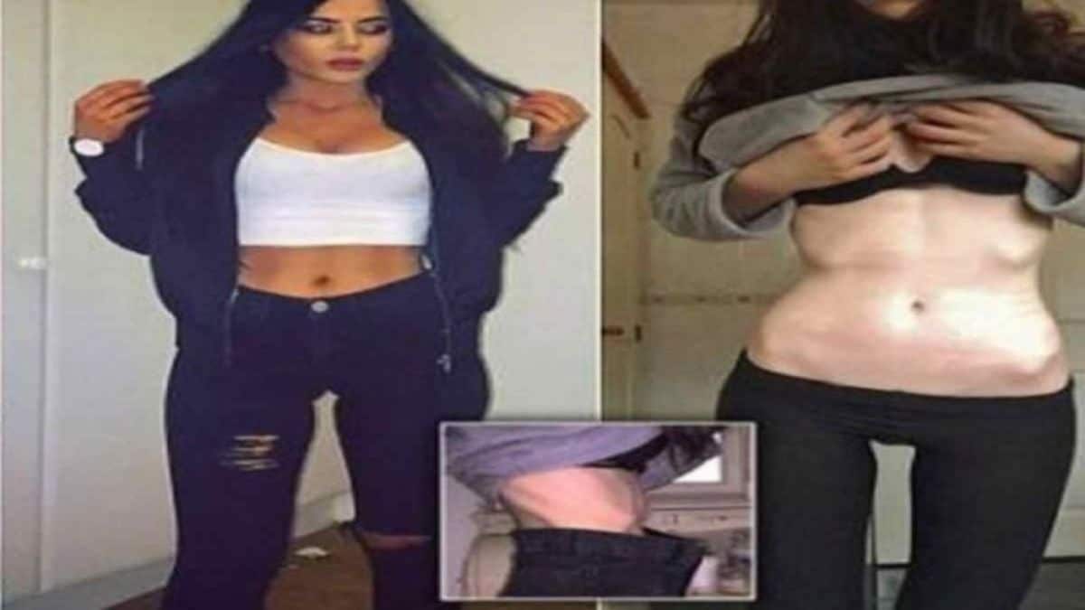 Είχε πάθει εμμονή με το σώμα της και έφτασε τα 41 κιλά – Όταν όμως είδε το πρόσωπο της μητέρας της…
