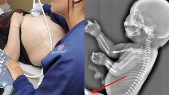 Έγκυος παίρνει την απόφαση να κάνει έκτρωση όταν βλέπει στον υπέρηχο ότι το μωρό της… – Θα σοκαριστείτε