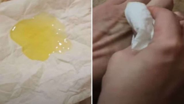 “Πότισε” μια χαρτοπετσέτα με ελαιόλαδο και έτριψε το χέρι του – Λίγα λεπτά μετά είχε απαλλαχτεί από…