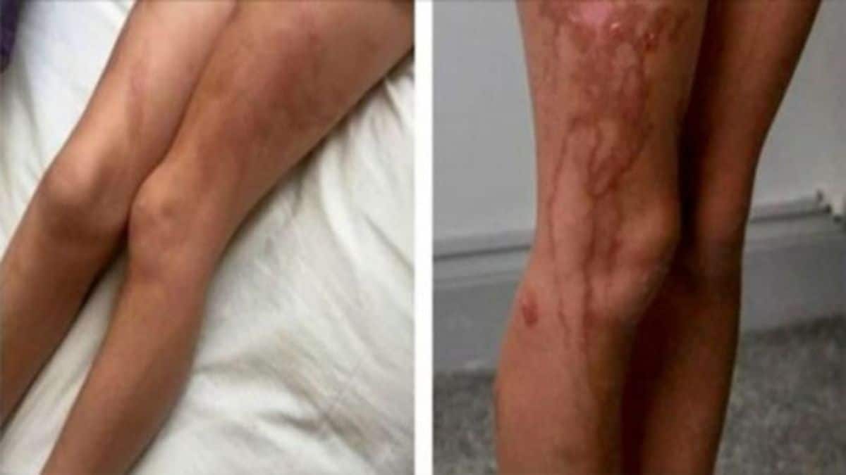 Μητέρα δεν μπορούσε να καταλάβει πως δημιουργήθηκαν αυτά τα «εγκαύματα» στην κορούλα της – Μέχρι που θυμήθηκε αυτό!