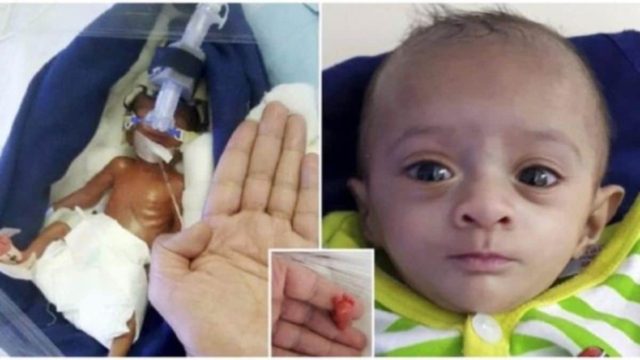 Μωρό που όταν γεννήθηκε ζύγιζε λιγότερο από μία σοκολάτα έγινε το μικρότερο μωρό που κατάφερε ποτέ να επιβιώσει