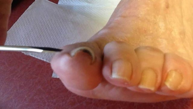 Μπαίνουν τα νύχια μέσα στο κρέας τον ποδιών σας; Δείτε τρόπους για να αποφύγετε το χειρουργείο!