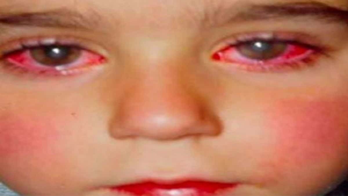 8χρονος έχασε την όραση του από ένα παιχνίδι που όλα τα παιδιά έχουν – Μεγάλη προσοχή