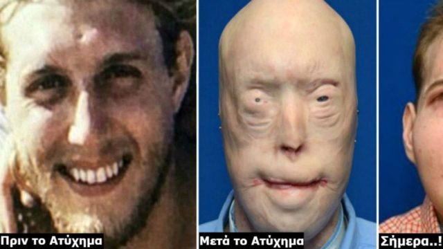Θυμάστε τον πυροσβέστη που είχε κάψει ολοσχερώς το πρόσωπό του εν ώρα υπηρεσίας; – Δείτε την τεράστια αλλαγή του και θα τα χάσετε