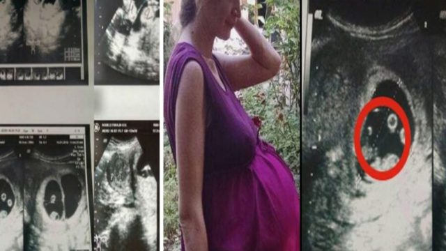 Όταν οι γιατροί είδαν το υπερηχογράφημα 36χρονης εγκύου φοβήθηκαν να την αγγίξουν – Δεν είχαν αντιμετωπίσει ποτέ κάτι παρόμοιο