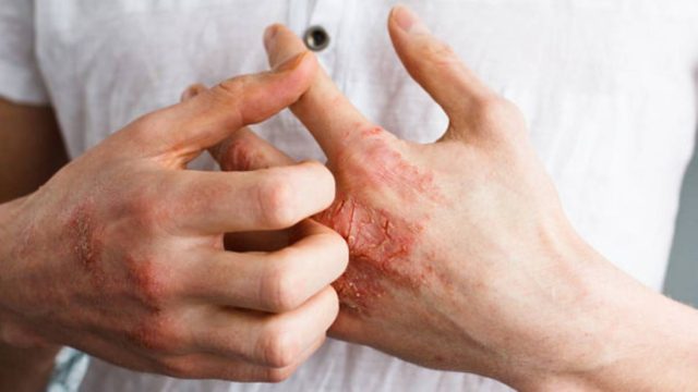 LEO Pharma: Θετικά τα αποτελέσματα της κρέμας delgocitinib σε ενήλικες ασθενείς με μέτριο έως σοβαρό χρόνιο έκζεμα άκρας χειρός