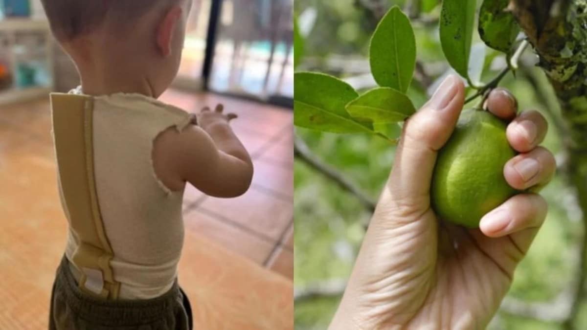 Μητέρα κρούει τον κώδωνα του κινδύνου: Μωρό έπαθε φρικτά εγκαύματα από ένα λεμόνι – «Ξαφνικά είδα σημάδια»