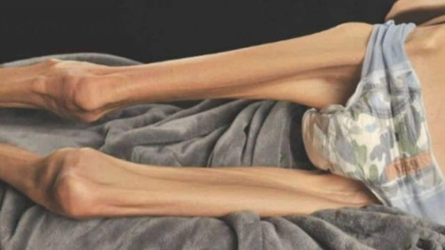 Πριν 5 χρόνια κόντεψε να πεθάνει από νευρική ανορεξία – Σήμερα, δημοσιεύει φωτογραφίες της με μπικίνι