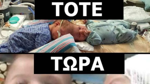 Θυμάστε τα σιαμαία που ήταν ενωμένα στο κεφάλι και οι γιατροί τα χειρουργούσαν για 20 ώρες; Δείτε τα να αγκαλιάζονται για 1η φορά!