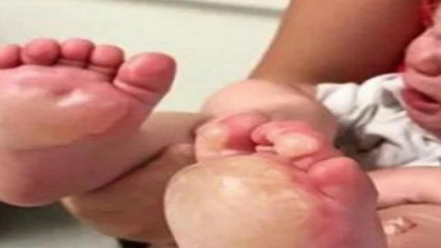 Μητέρα γυρίζει σπίτι και βλέπει τις πατούσες του μωρού της πρησμένες σαν μπάλες – Όταν κατάλαβε τι είχε συμβεί, έπαθε σοκ!