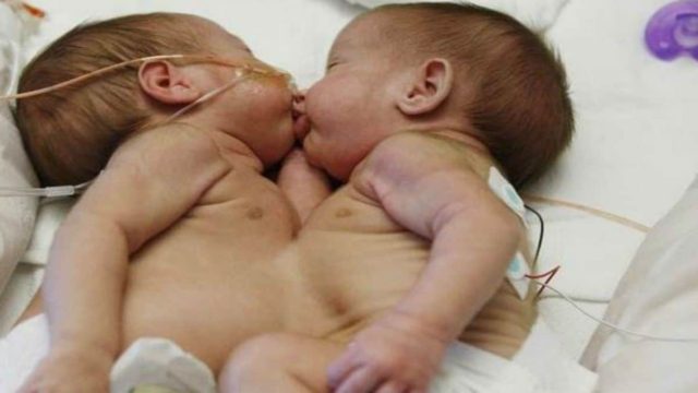 Μητέρα ζήτησε το διαχωρισμό των σιαμαίων μωρών της με ποσοστό επιτυχίας μόλις 5% – Η συνέχεια σοκάρει… (Video)