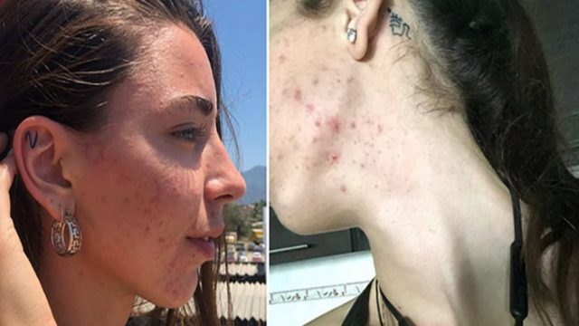 27χρονη πρώην βίγκαν εξομολογείται: «Ήμουν συνέχεια άρρωστη, μου έπεσαν τα μαλλιά. Έφαγα κρέας και σώθηκε η ζωή μου» (Video)