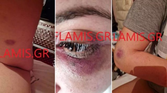 «Θα με σκοτώσει»: Κραυγή αγωνίας από 31χρονη που κατήγγειλε ξυλοδαρμό από τον σύντροφό της στην Πάτρα!