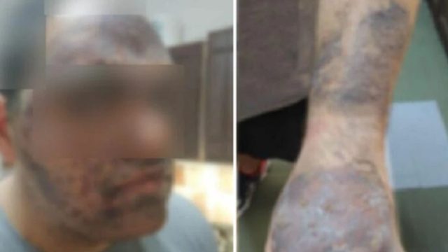 Φρίκη στην Κρήτη: Εργαζόμενος ξενοδοχείου κάηκε με λάδι σε πρόσωπο και χέρια – «Καίγομαι, πονάω» ούρλιαζε