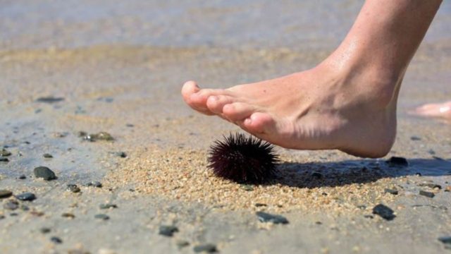 Πατήσατε αχινό; Nα τι πρέπει να κάνετε ακριβώς
