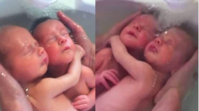 Δίδυμα δεν έχουν καταλάβει ότι γεννήθηκαν και παραμένουν αγκαλιασμένα όπως ήταν μέσα στην κοιλιά της μαμάς τους