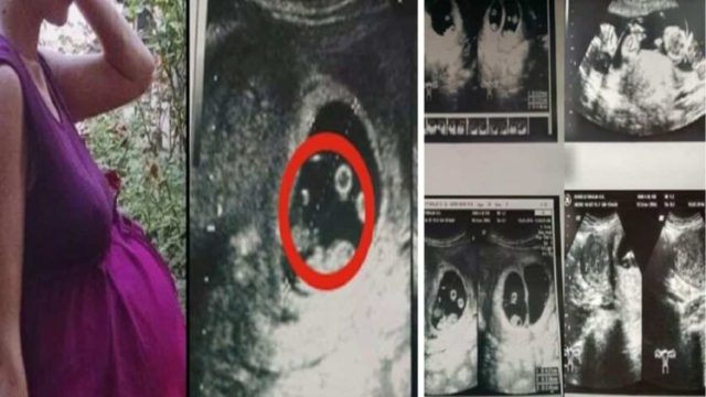 Όταν οι γιατροί είδαν το υπερηχογράφημα της 36χρονης εγκύου φοβήθηκαν ακόμη και να την αγγίξουν – Δεν είχαν αντιμετωπίσει ποτέ κάτι παρόμοιο (photos)