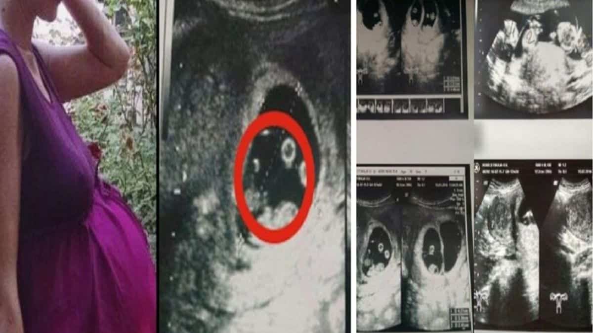 Όταν οι γιατροί είδαν το υπερηχογράφημα της 36χρονης εγκύου φοβήθηκαν ακόμη και να την αγγίξουν – Δεν είχαν αντιμετωπίσει ποτέ κάτι παρόμοιο (photos)