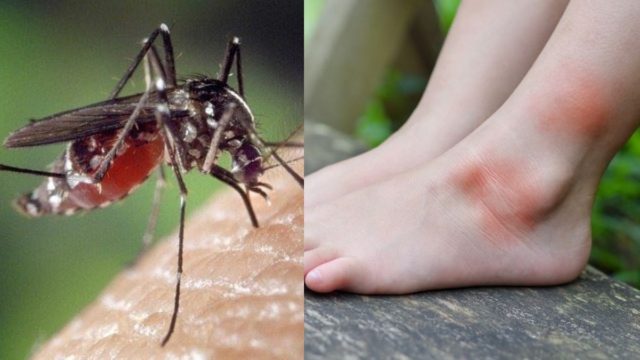 Έντονη φαγούρα από τα κουνούπια; 3 σπιτικές λύσεις για να ανακουφιστείτε εύκολα και ανέξοδα