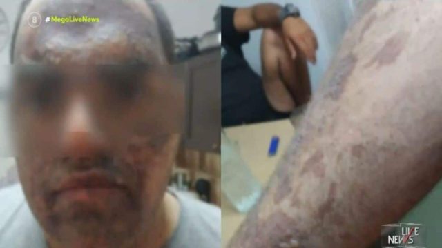 Κρήτη: «Πονάει αφόρητα! Αδιαφορούν για τα εγκαύματα του παιδιού μου. Μίλησα με τον κ. Άδωνι Γεωργιάδη και…» – Καταγγελίες “βόμβα” από την μητέρα του 20χρονου (Video)