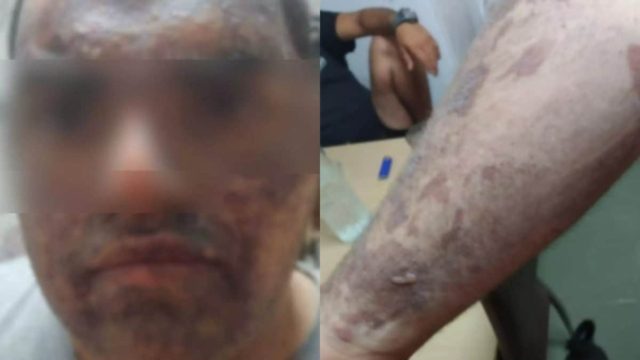 Κρήτη: Ξεσπά η μητέρα του μάγειρα που κάηκε με λάδι – «Το παιδί φώναζε, δεν άντεχε τους πόνους» (video)