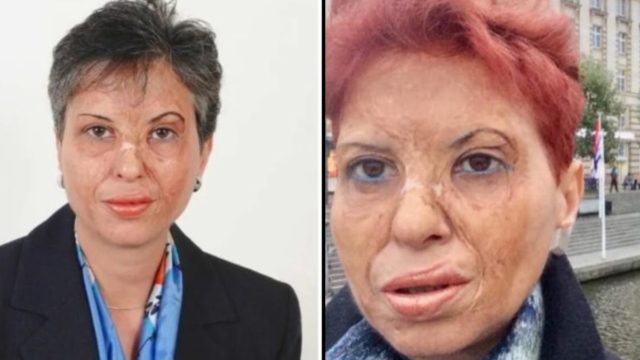Καλλιόπη Αθανασιάδη: Η επιζήσασα ενός φρικτού ατυχήματος που έγινε η κορυφαία χειρουργός της Ελλάδας