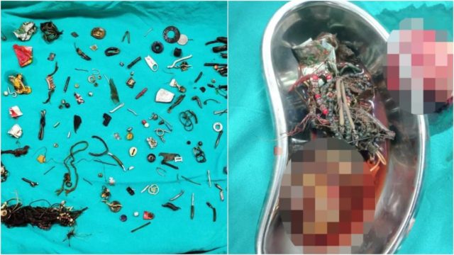 Ινδία: Πήγε με στομαχόπονο στο νοσοκομείο και του έβγαλαν από το έντερο 60 αντικείμενα – Η σπάνια πάθηση που τον κάνει να «καταπίνει αναγκαστικά πράγματα που δεν είναι τροφή»