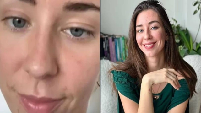 27χρονη vegan αποκαλύπτει: «Ήμουν διαρκώς άρρωστη και μου έπεσαν τα μαλλιά, έφαγα κρέας και έσωσα τη ζωή μου»