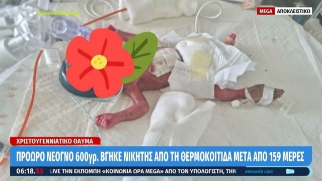 Ημέρα χαράς στο νοσοκομείο του Ρίου: Μωράκι που γεννήθηκε πρόωρα και ζύγιζε 600 γραμμάρια βγήκε νικητής μετά από 159 ημέρες (video)
