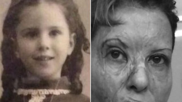 Καλλιόπη Αθανασιάδη: Συγκλονίζει η κορυφαία θωρακοχειρουργός 54 χρόνια μετά το φρικτό ατύχημα – «Ένα σημάδι αντίφασης στον κόσμο…»
