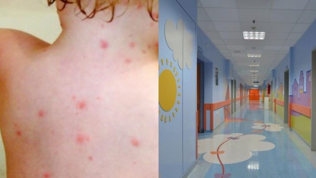 Σε έξαρση η ιλαρά στην Ελλάδα: Έντονη ανησυχία των ειδικών – Η περιοχή που είναι στο «κόκκινο»
