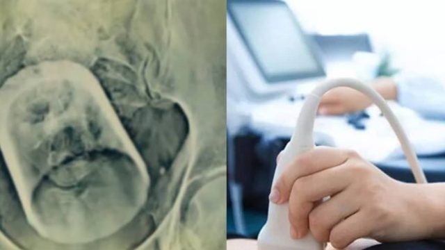 Πήγε στο νοσοκομείο επειδή είχε έντονους πόνους στο στομάχι – Όταν οι γιατροί είδαν τις εξετάσεις του «πάγωσαν» με αυτό που αντίκρισαν