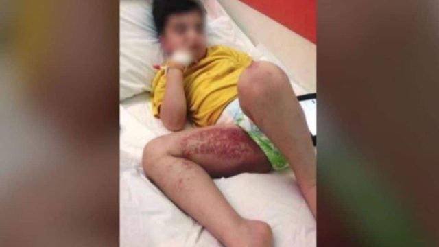 Συναγερμός στο Ναύπλιο: Θαλάσσιες ανεμώνες «επιτέθηκαν» σε παιδιά – Τι πρέπει να κάνετε αν σας τσιμπήσουν;