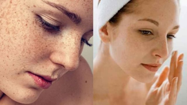 Πανάδες στο πρόσωπο: 2 φυσικά tips για να απαλλαγείτε οριστικά