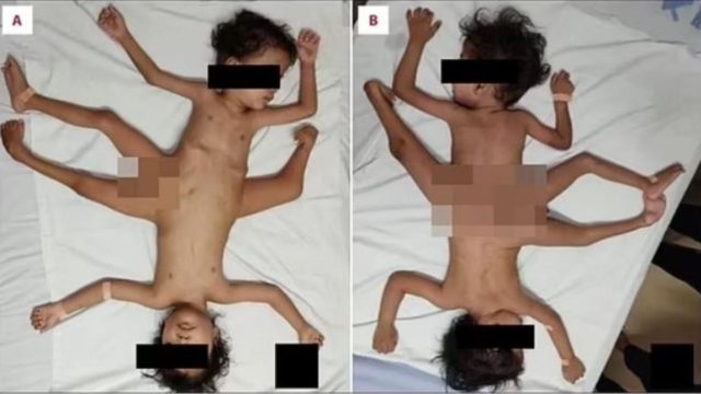 Σιαμαία ενωμένα στη λεκάνη – Έχουν τρία πόδια και μοιράζονται το ίδιο… πέος