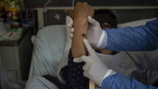 Έντονη ανησυχία για μετάδοση της ευλογιάς των πιθήκων στην Ελλάδα: Ποιοι πρέπει να κάνουν το εμβόλιο και τα μέτρα προφύλαξης