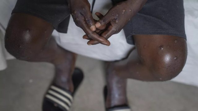 Mpox: Εντοπίστηκε το πρώτο κρούσμα της πιο μολυσματικής παραλλαγής εκτός Αφρικής, στη Σουηδία