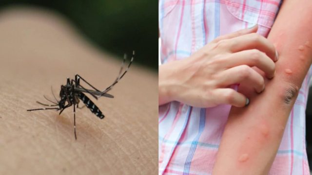 Τσίμπημα από κουνούπι: 4 φυσικές θεραπείες για ανακούφιση της φαγούρας