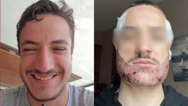 Τραγικό: 24χρονος αυτοκτόνησε μετά από αποτυχημένη επέμβαση για μούσια στην Τουρκία