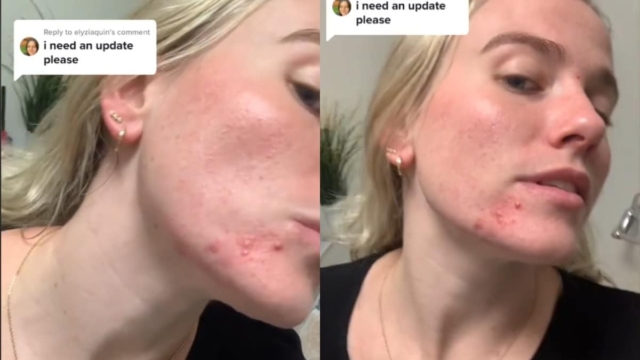 Επείγουσα προειδοποίηση: Το viral Tik Tok περιποίησης της επιδερμίδας «μπορεί να σας σημαδέψει» (Video)
