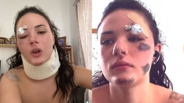 Σπαράζει 18χρονη που σώθηκε σε τροχαίο με μηχανή: «Έπεσα κάτω και σερνόμουν…» (video)