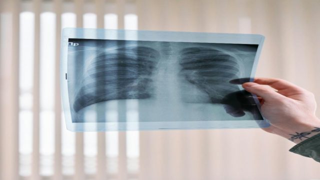 Καρκίνος του πνεύμονα: Επτά σημάδια που δεν πρέπει να αγνοήσεις
