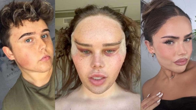 Trans Influencer αποκαλύπτει τα τρελά αποτελέσματα της πλαστικής επέμβασης ματιών “Foxy”