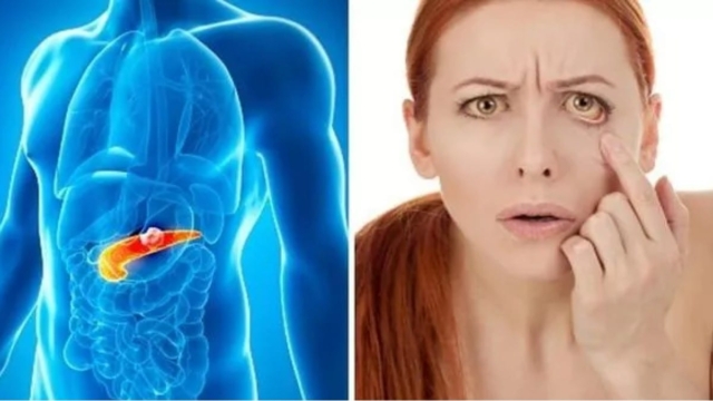 Καρκίνος στο πάγκρεας: Αυτά είναι τα πιο έντονα προειδοποιητικά σημάδια
