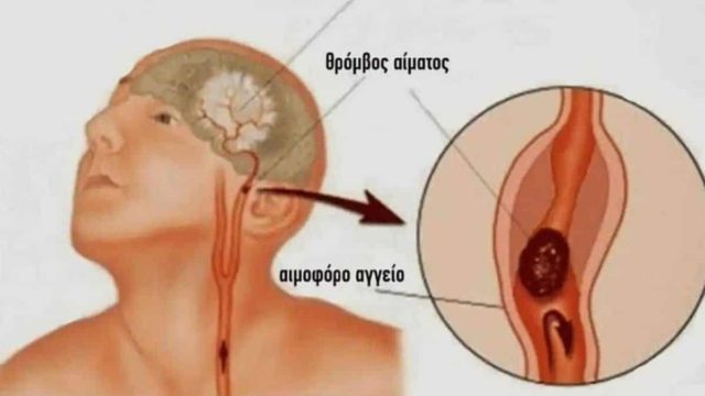 Tι κάνουμε σε περίπτωση εγκεφαλικού; – Παίρνει μόνο 1 λεπτό για να το διαβάσετε