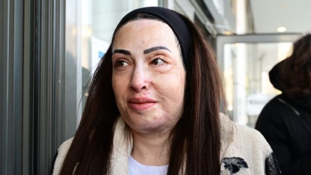 Ιωάννα Παλιοσπύρου: Ξανά στο Εφετείο για την επίθεση με βιτριόλι – «Πηγαίνω για να εξηγήσω την ζημιά, που έχει υποστεί η υγεία μου»
